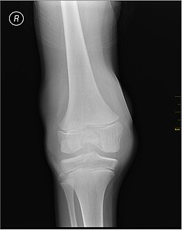 X-ray of Hemarthrosis