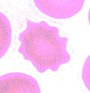 Micrograph of an echinocyte on a peripheral blood smear.jpg