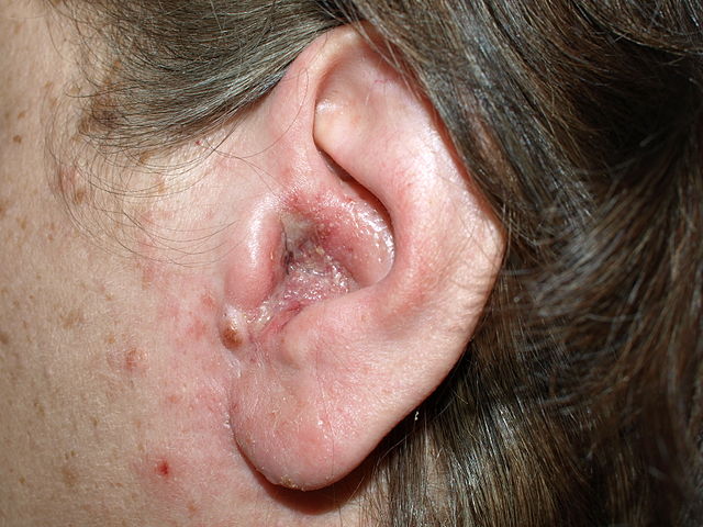 Exudate over a background of redness on the external ear canal of an adult