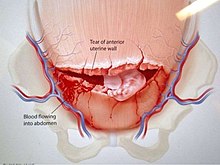 Transeverse uterine rupture Rupture Tranverse.jpg