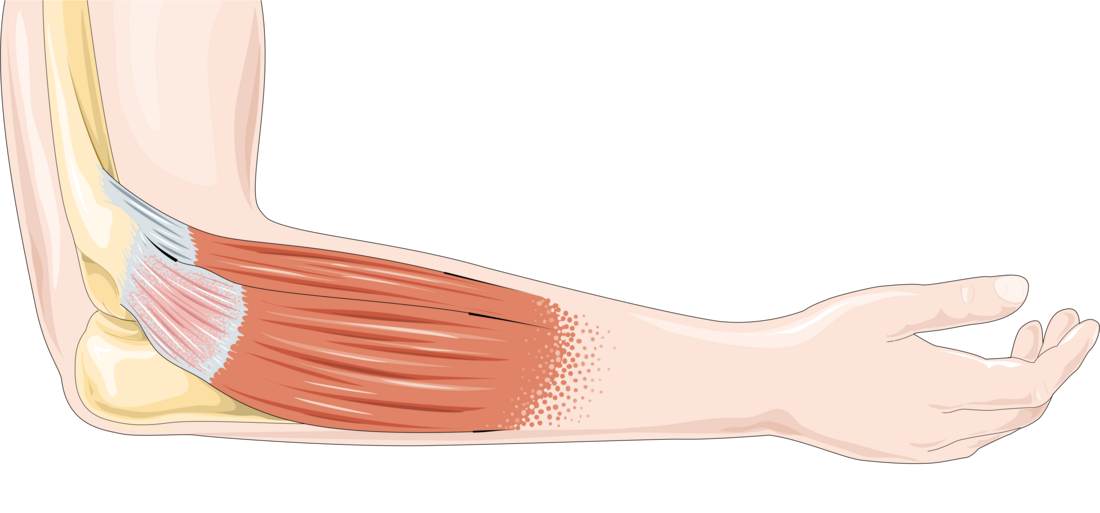 Tendinopathie