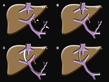 Steps in a TIPS procedure: A) portal hypertension has caused the coronary vein (arrow) and the umbilical vein (arrowhead) to dilate and flow in reverse. This leads to varices in the esophagus and stomach, which can bleed; B) a needle has been introduced (via the jugular vein) and is passing from the hepatic vein into the portal vein; c) the tract is dilated with a balloon; D) after placement of a stent, portal pressure is normalized and the coronary and umbilical veins no longer fill. Tips schematic.JPG