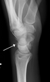Triquetral fracture as seen on lateral view of a radiograph.