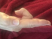 Side view of trigger finger in the right middle finger 20230326 Trigger finger - right middle finger.jpg