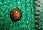 Thumbnail for File:Bladder stone ruler.jpg