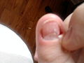 Category:Onychomycosis - Wikimedia Commons