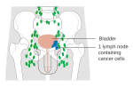 Thumbnail for File:Diagram showing stage N1 bladder cancer CRUK 444.svg