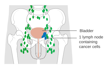 File:Diagram showing stage N1 bladder cancer CRUK 444.svg