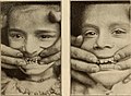Diseases of infancy and childhood (1914) (14769631554).jpg