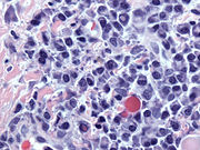 Atipski infiltrat plazma ćelija sa Russelovim (citoplazmatskim) i Dutcherovim (jedarnim) tijelima (H&E, 50x)