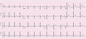 EKG Sinüs Aritmisi 79 bpm.jpg