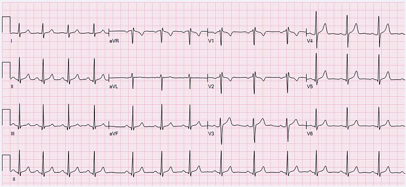 File:ECG Sinus Arrhythmia 79 bpm.jpg