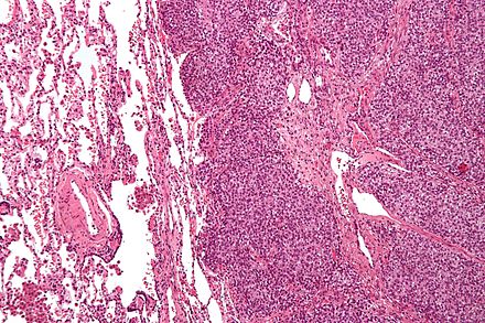 Micrograph of metastatic Ewing sarcoma with characteristic cytoplasmic clearing on H&E staining, which was shown to be PAS positive