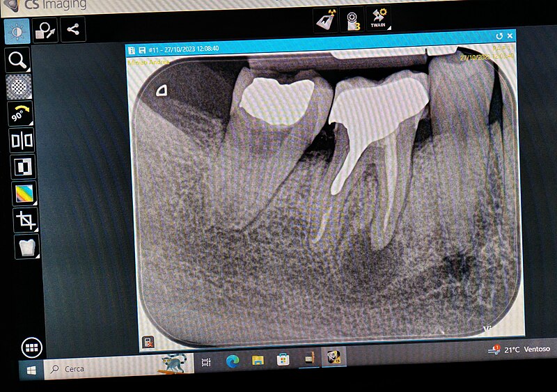 File:Granuloma sotto dente già devitalizzato - visione di lastra su schermo.jpg