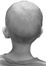 صورة مصغرة لـ نقص الشعر اليافعي "الضمور البقعي"