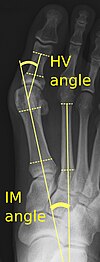 X-ray showing measurements of HV and IM angles of hallux valgus. HV and IM angles of hallux valgus.jpg