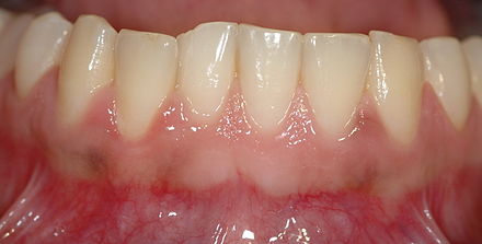 Zdrowe dziąsła mają różowy kolor i mocno przylegają otaczając zęby; nie krwawią podczas mycia czy jedzenia. Tam, gdzie kolor tkanki przechodzi z różowego w ciemniejszy zaczyna się błona śluzowa, która pokrywa również wnętrze policzków. Maleńkie wgłębienia (dziurki) w dziąsłach nie są objawem chorobowym.