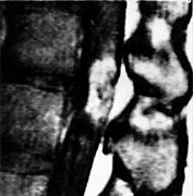 Contrast enhanced MRI of the conus medullaris and cauda equina of patient with VHL depicts a hemangioblastoma of the conus with extension into the nerve roots.