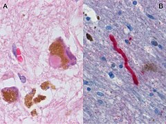 July 13: Biological specimen of substantia nigra in Parkinson's disease.