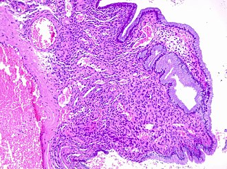 Histopathology of endocervical polyp: With endocervical epithelium and glands (mucinous columnar linings), edematous stroma and clear congestion. H&E stain. Histopathology of endocervical polyp.jpg