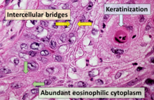 Main histopathology features of squamous-cell carcinoma Histopathology of squamous-cell carcinoma.png