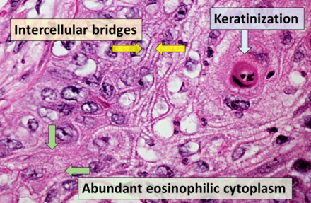 Main histopathology features of squamous-cell carcinoma.