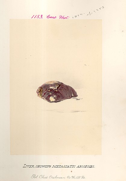 File:Liver of Pvt. Charles Crelman (CP 1153), National Museum of Health and Medicine. (5621700369).jpg