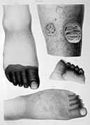 Category:Gangrene in lower limbs - Wikimedia Commons