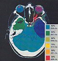 Thumbnail for Optic nerve sheath meningioma