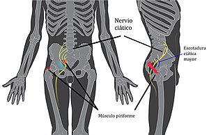 Piriformis syndrome-es.jpg