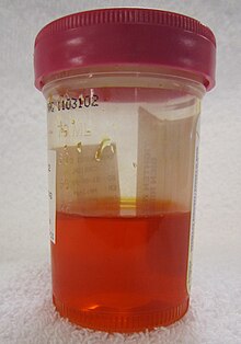 The characteristic orange-colored urine after taking Phenazopyridine Pyridiumurine.jpg