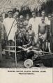 Making native cloth. Sierra Leone. Umbilical hernia, 1910s