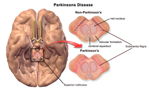 Blausen 0704 ParkinsonsDisease