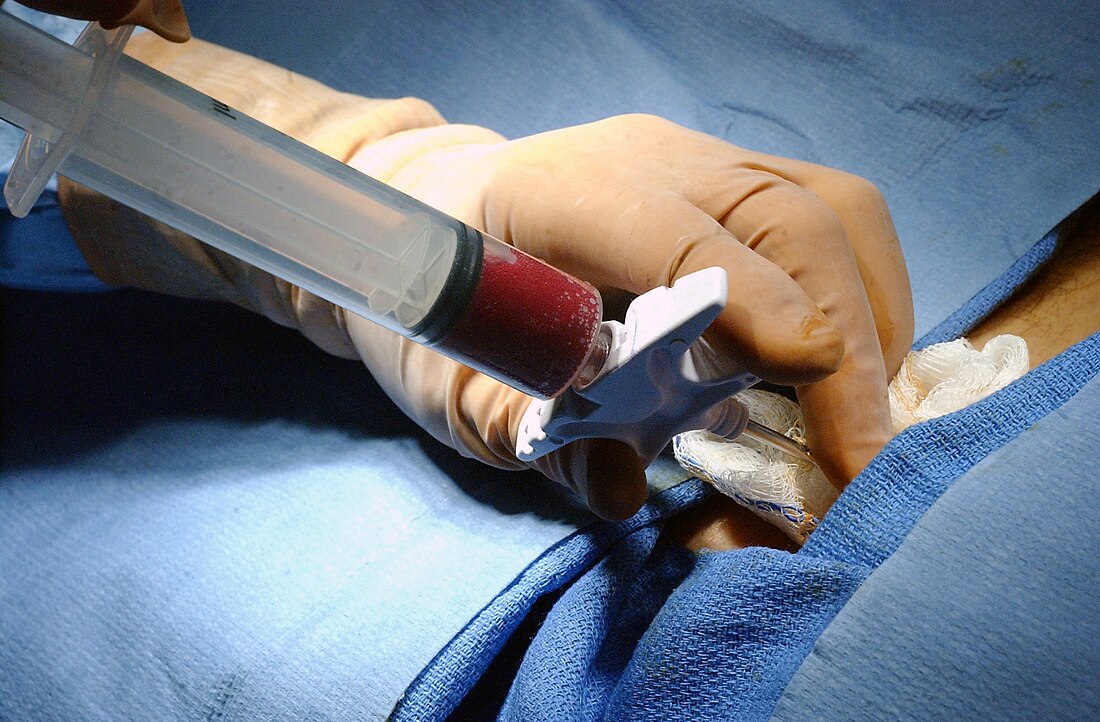 File:Bone marrow biopsy.jpg