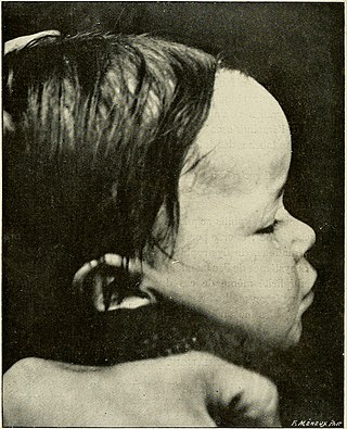 <span class="mw-page-title-main">High anterior hairline</span> Medical condition
