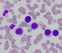 اللوكيميا مرض يصيب خلايا الدم الحمراء صواب خطأ