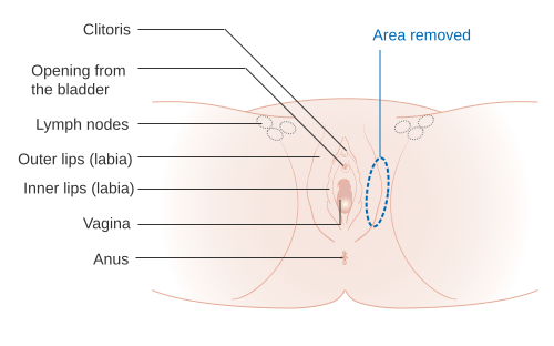 File:Diagram showing a wide local excision of the vulva CRUK 088.svg