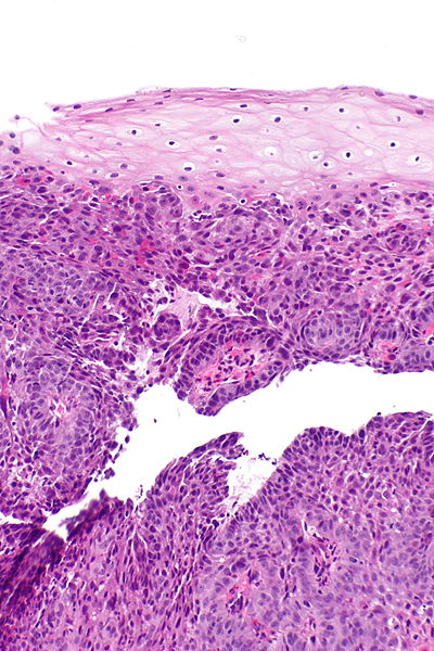 File:Esophageal squamous cell carcinoma -- intermed mag.jpg