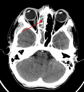 <span class="mw-page-title-main">Sinusitis</span> An inflammation of the mucous membrane that lines the sinuses resulting in symptoms