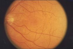 Fundus retinopathy EDA03.JPG