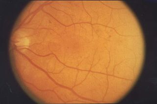<span class="mw-page-title-main">Retinopathy</span> Medical condition