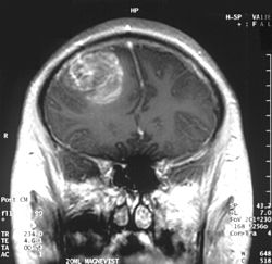 Coronal تصوير بالرنين المغناطيسي with contrast of a glioblastoma WHO grade IV in a 15-year-old boy