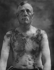 German-American farmer John Meints of Minnesota was tarred and feathered in August 1918 for allegedly not supporting war bond drives.