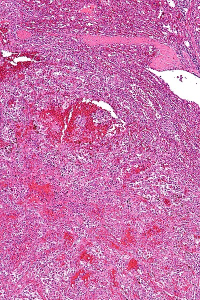 File:Littoral cell angioma of the spleen - intermed mag.jpg