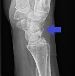 Triquetral avulsion fracture as seen on lateral أشعة سينية of the wrist