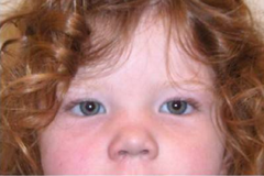 Фото трипло. Синдром трисомии по х-хромосоме. Широко расставленные глаза синдром.