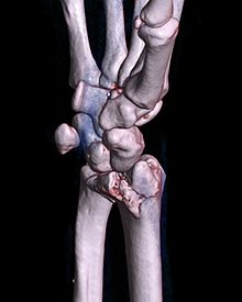 Colles Fracture - Physiopedia