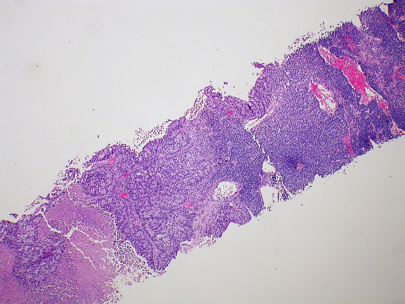 File:Adenocarcinoma and small cell, B-cell lymphoma - Case 276 (9658097704).jpg