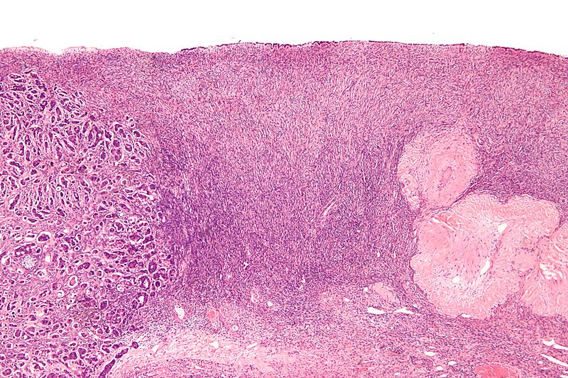 File:Adenocarcinoma of the breast metastatic to the ovary - low mag.jpg