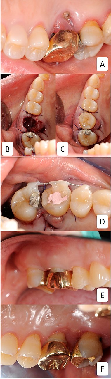 Autotransplantation of wisdom tooth into unrestorable first permanent molar position.jpg